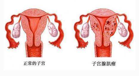 子宫肌瘤是如何导致流产和不孕的