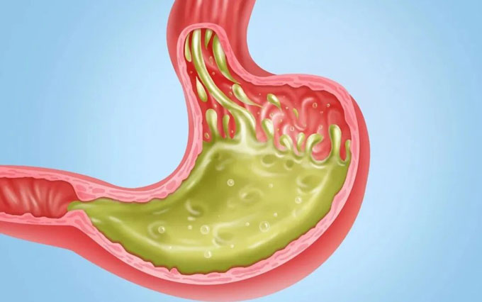 中西合璧精准施治胃食管反流病